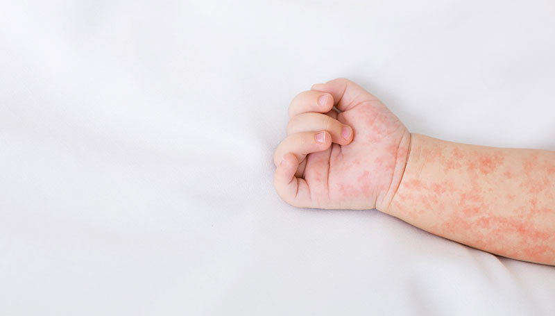 Morbillo in aumento