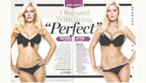 Salute: regole più severe per le protesi al seno