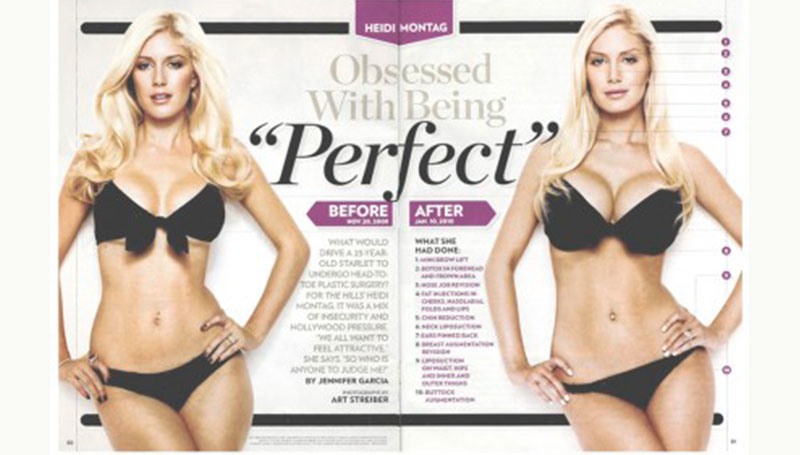 Salute: regole più severe per le protesi al seno