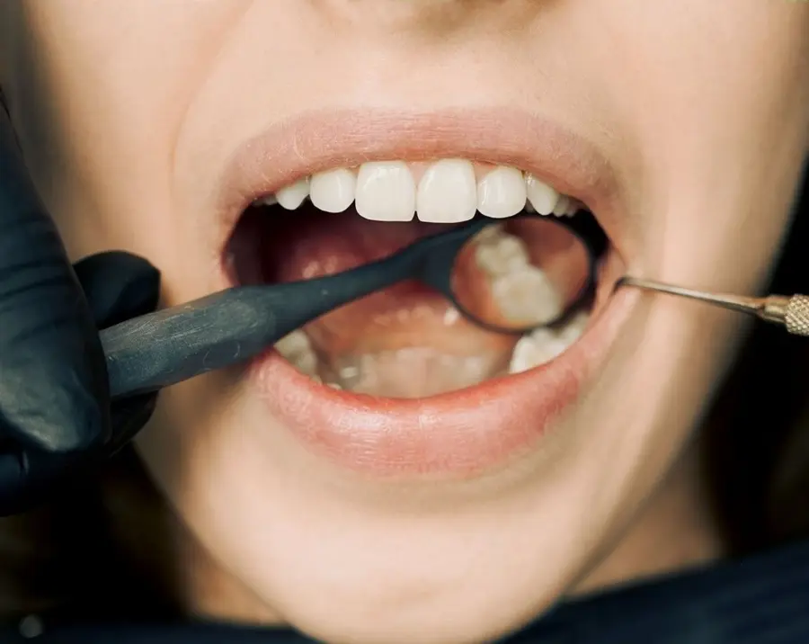 Carie sui denti da latte: perché curarle