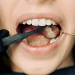 Carie sui denti da latte: perché curarle