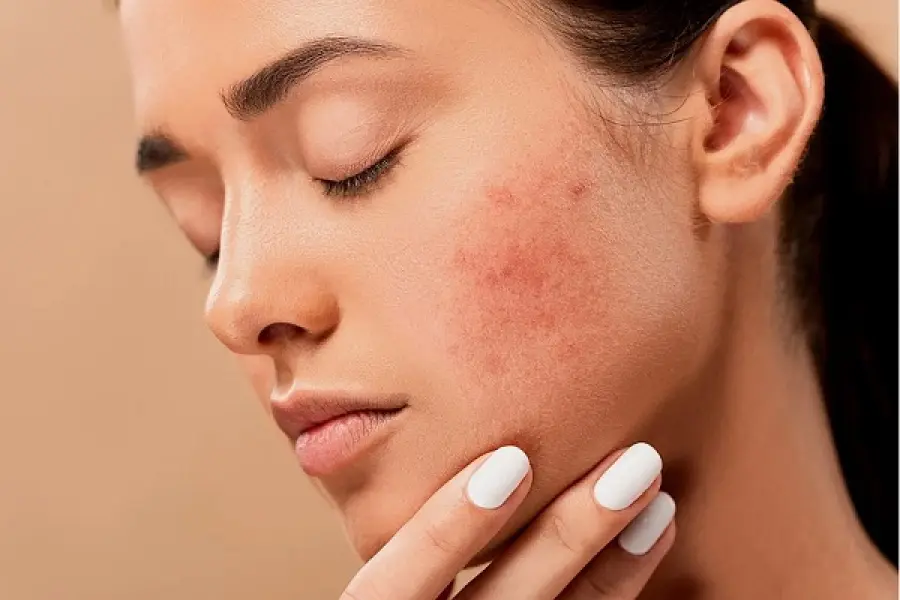 Gli effetti psicologici dell’acne giovanile