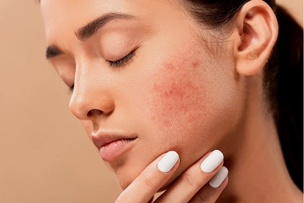 Gli effetti psicologici dell’acne giovanile