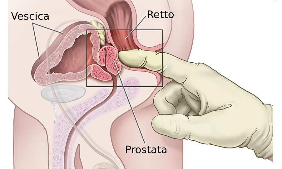 Problemi di prostata: come aiutare il mio compagno