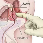Problemi di prostata: come aiutare il mio compagno