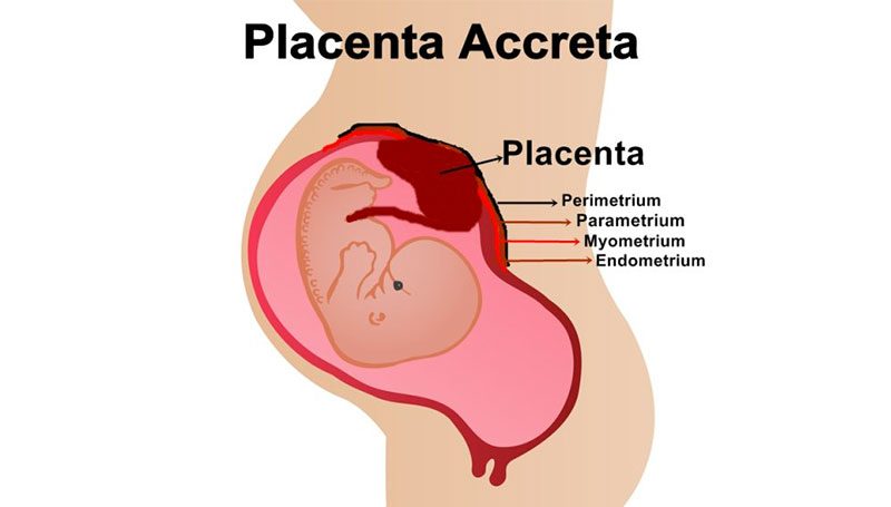 Placenta accreta, di cosa si tratta?