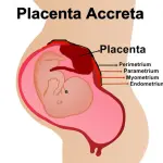 Placenta accreta, di cosa si tratta?