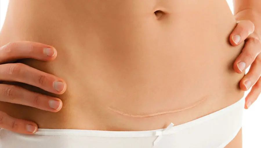Cicatrice cesareo: come eliminarla