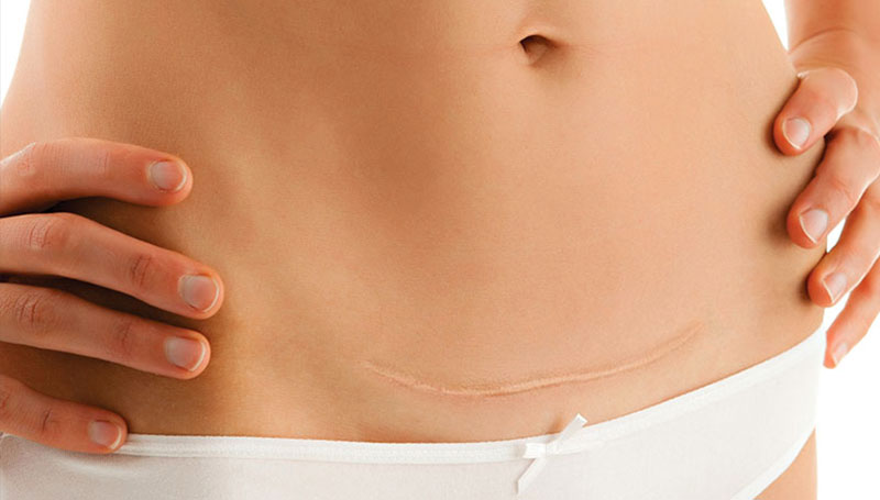 Cicatrice cesareo: come eliminarla