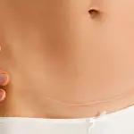 Cicatrice cesareo: come eliminarla