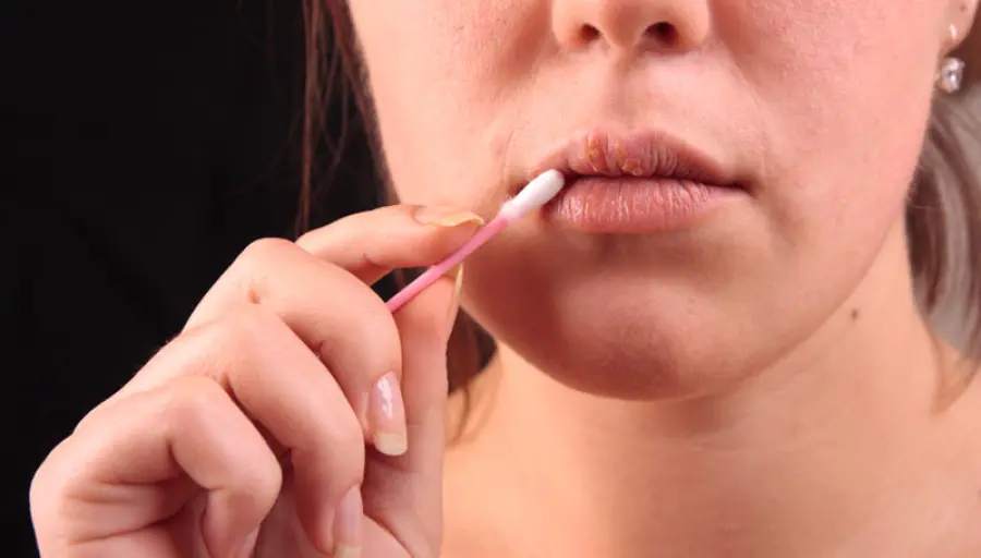 I rimedi contro l'herpes labiale