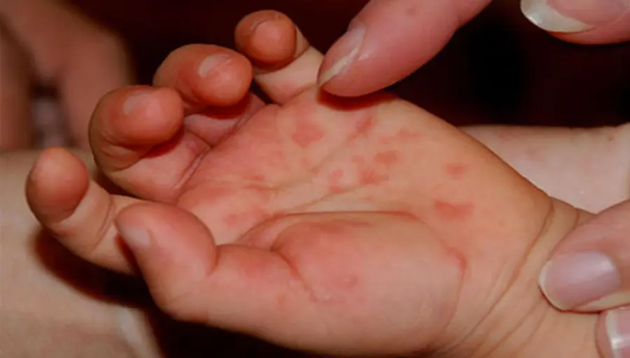 La malattia mani – piedi – bocca