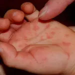 La malattia mani – piedi – bocca