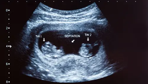 La gravidanza isterica