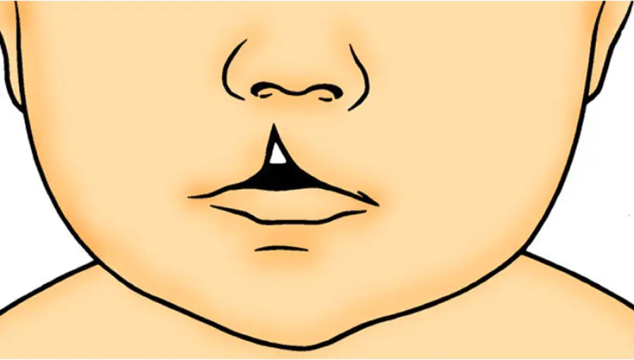 Labbro leporino: più di un problema estetico