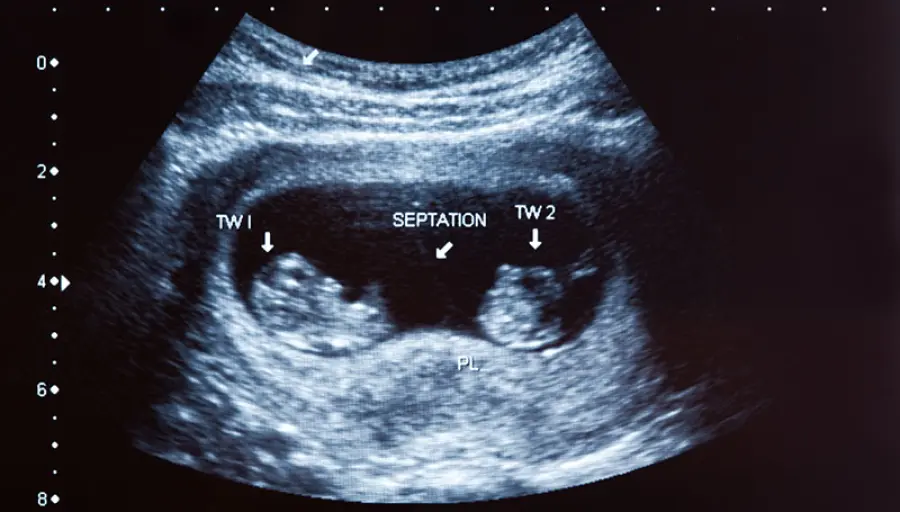 La gravidanza isterica