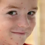 La varicella è arrivata, come bisogna comportarci?