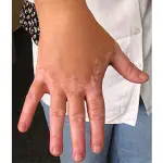 La vitiligine