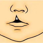 Labbro leporino: più di un problema estetico