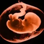 Patologie del liquido amniotico: il polidramnios