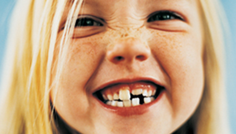 Correggere i denti storti