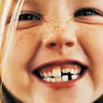 Correggere i denti storti