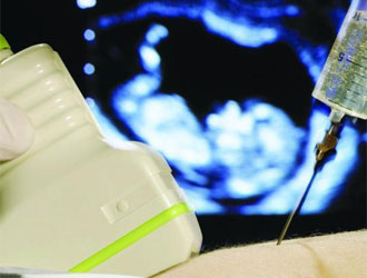 Diagnosi prenatale: l’amniocentesi