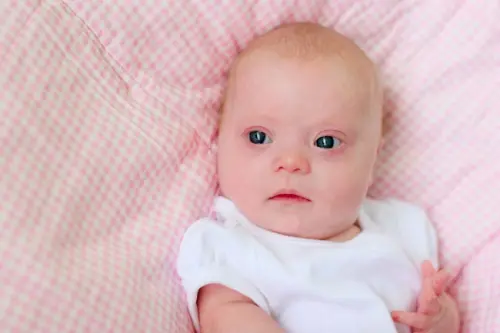 Sindrome di Down, l'importanta della transulecenza nucale