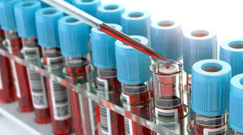 Sindrome di Down: basta un esame del sangue per diagnosticarla