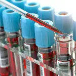 Sindrome di Down: basta un esame del sangue per diagnosticarla