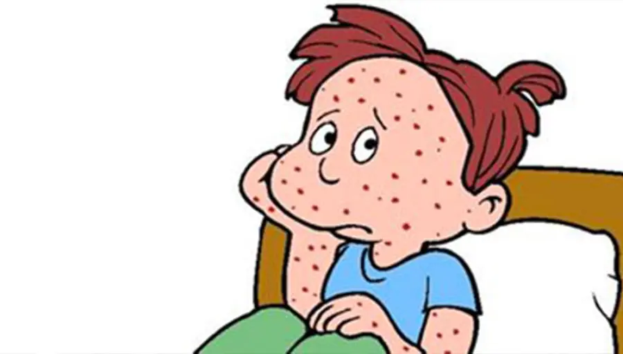 Morbillo: allarme in Italia, alta incidenza