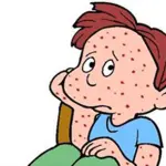 Morbillo: allarme in Italia, alta incidenza