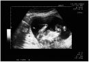 Diagnosi prenatale: invasiva e non invasiva