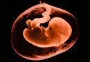 Patologie del liquido amniotico: il polidramnios