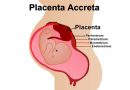 Placenta accreta, di cosa si tratta?